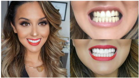 Close-up view of cosmetic dental veneers