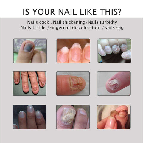 Nail Repair Treatment Gel bottle and application