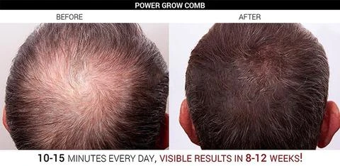 Professional Hair Regrowth Laser Comb design