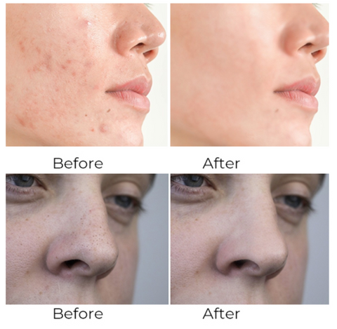 Blackhead Remover Pore Vacuum with multiple heads